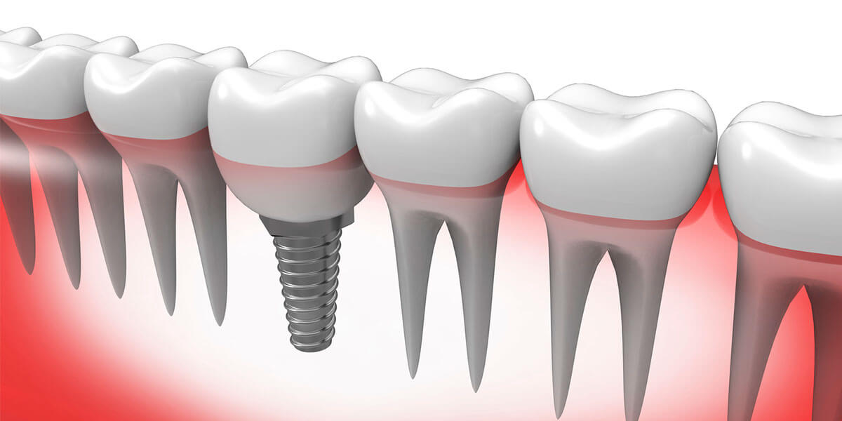 single implant graphic Dental Implant Graphic
