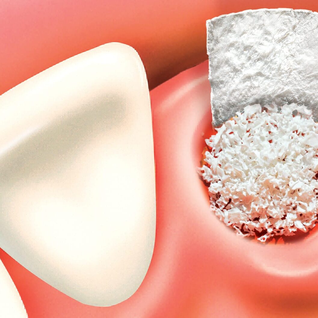 Bone Grafting